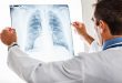 Пет митови за ракот на белите дробови во кои треба да престанеме да веруваме